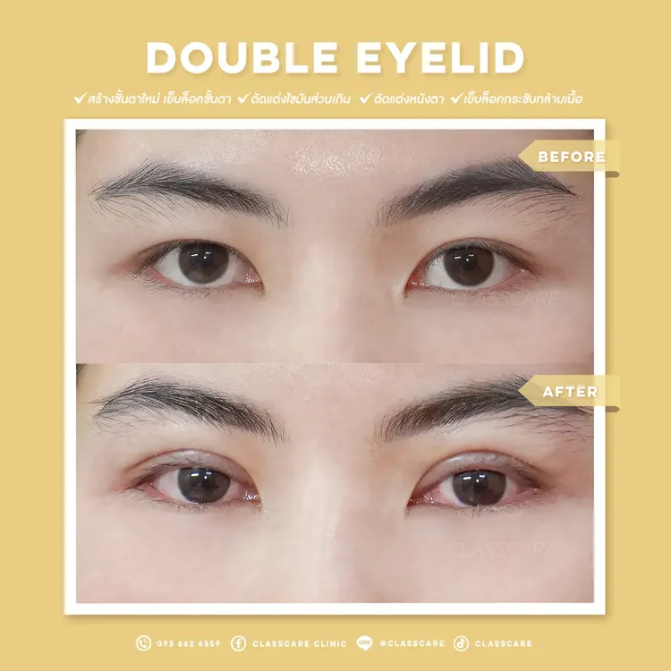 ตาสองชั้น ก่อน-หลัง (เฉพาะดวงตา)