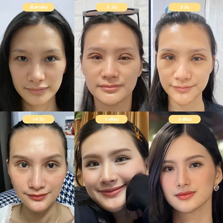 ลำดับเวลาการฟื้นตัวศัลยกรรมตาสองชั้น