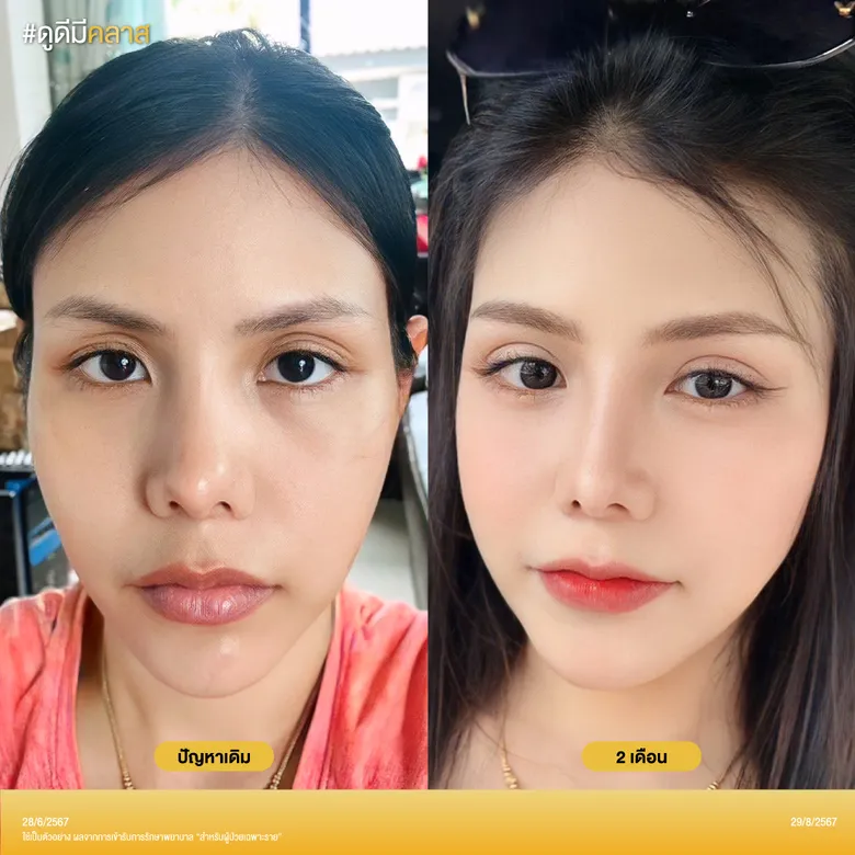 ศัลยกรรมเปลือกตา ก่อน-หลัง 2 เดือน