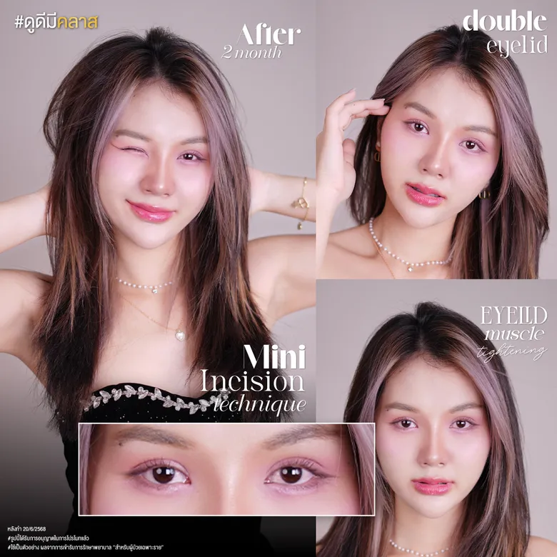 ตาสองชั้นแผลเล็ก หลัง 2 เดือน