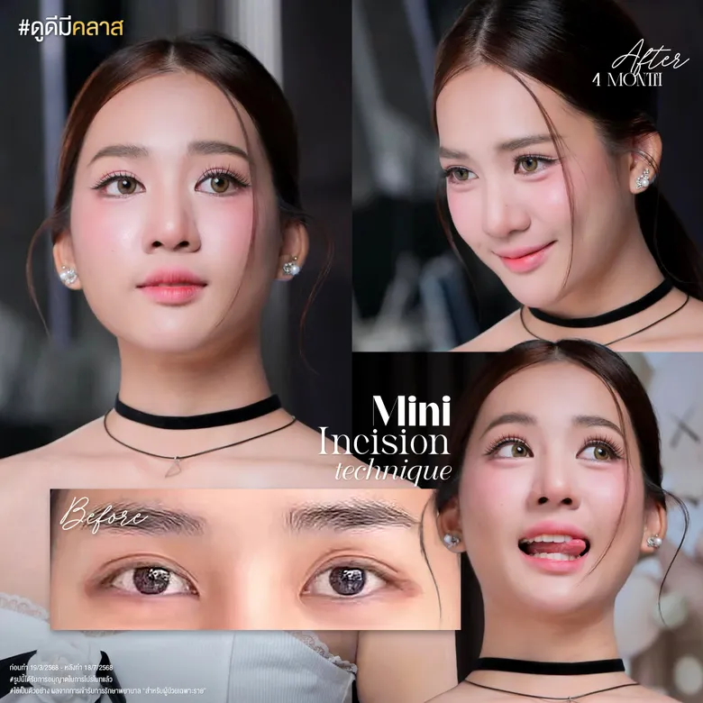 ตาสองชั้นแผลเล็ก หลัง 4 เดือน