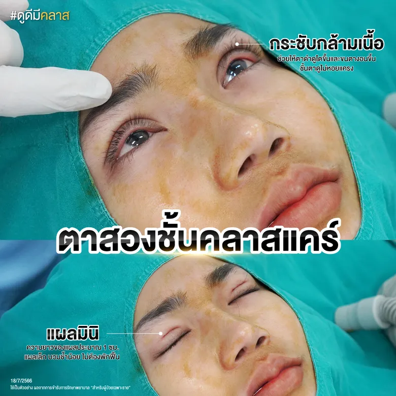 กระชับกล้ามเนื้อตาแผลเล็กขณะทำ
