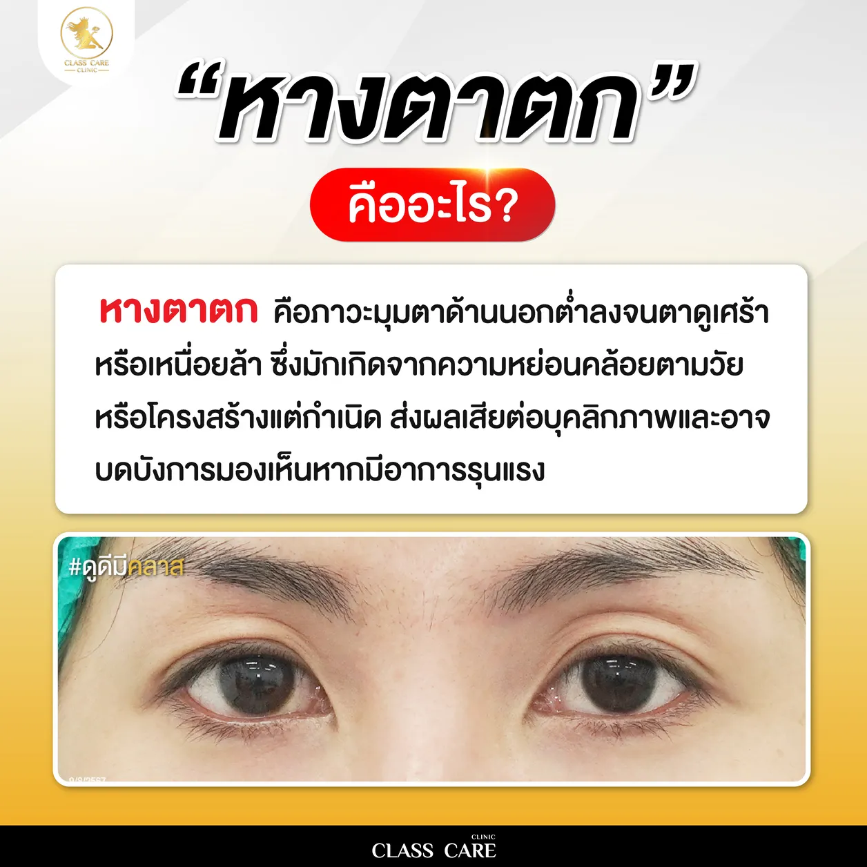หางตาตก คืออะไร?