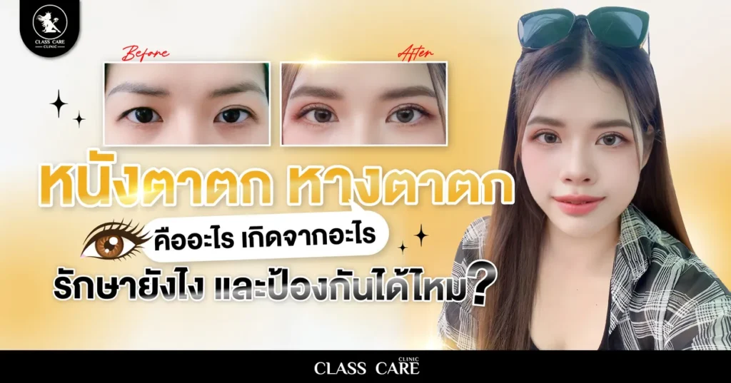 หางตาตก คืออะไร สาเหตุ อาการ วิธีรักษา และการป้องกัน