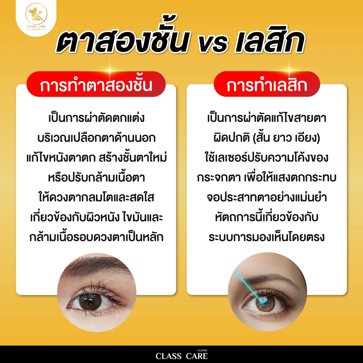 ตาสองชั้น vs เลสิก