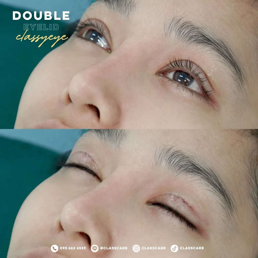 ผลลัพธ์หลังทำทันที-01