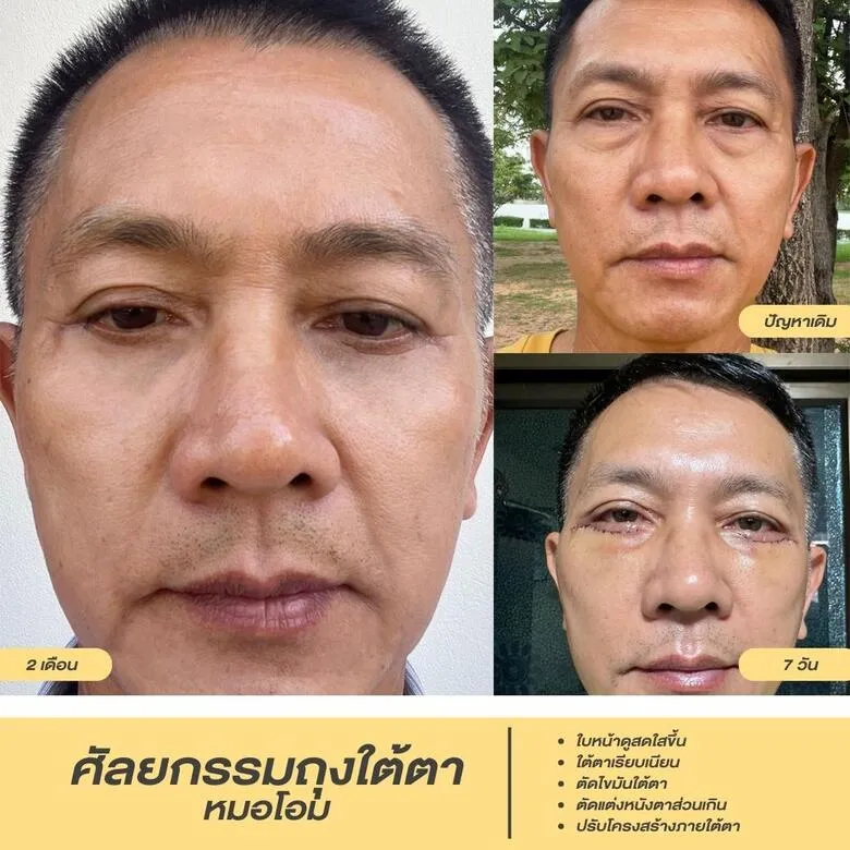 ศัลยกรรมถุงใต้ตาผู้ชาย