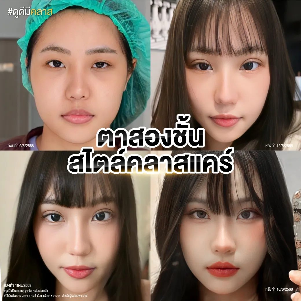 ตาสองชั้นสไตล์เฉพาะของคลินิก