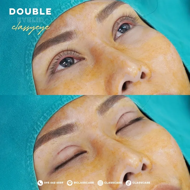 ชั้นตาสวย หลังทำทันที