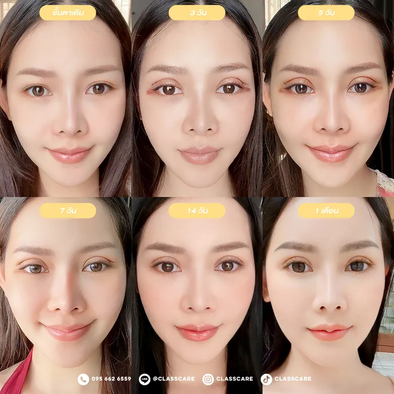 ลำดับเวลาการพักฟื้น 1 เดือน หลังทำตาสองชั้น