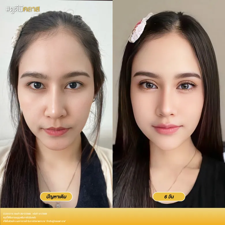 อัปเดตผลลัพธ์หลังทำตาสองชั้น 6 วัน