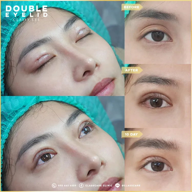 อัปเดตผลลัพธ์เทคนิค Classy Eye หลังทำ 10 วัน