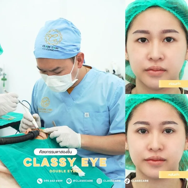การทำศัลยกรรมตาสองชั้นด้วยเทคนิค Classy Eye