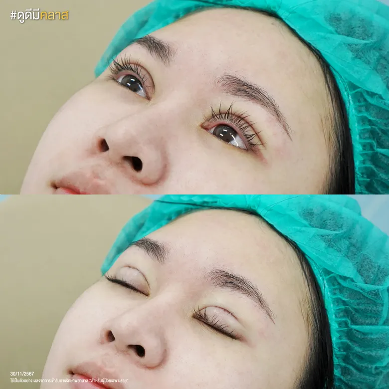 ภาพซูมความละเอียดของฝีเย็บหลังผ่าตัดทันที