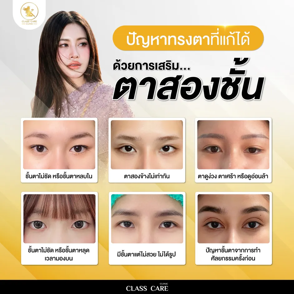 ปัญหาทรงตาที่แก้ไขได้ด้วยการทำตาสองชั้น