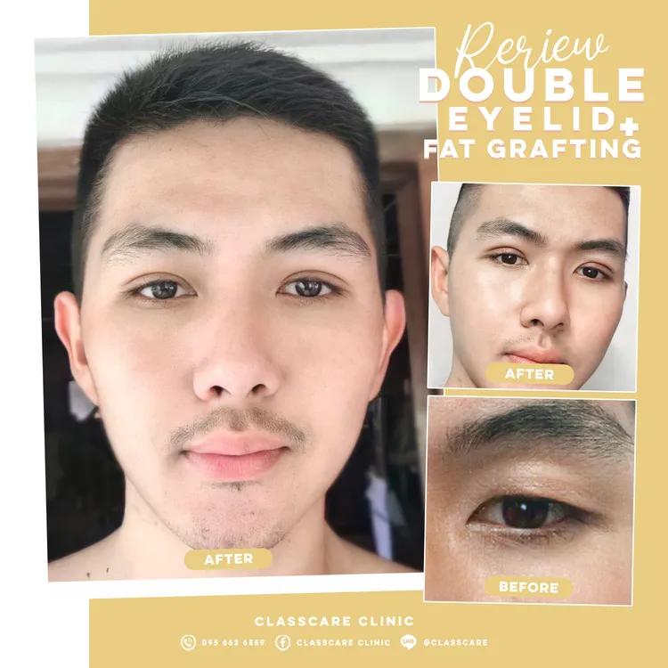 รีวิวตาสองชั้นร่วมกับการเติมไขมัน