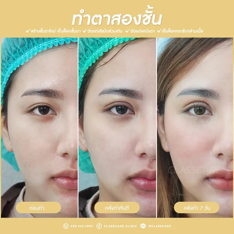 เปรียบเทียบผลลัพธ์ทันทีหลังทำและหลังทำ 7 วัน