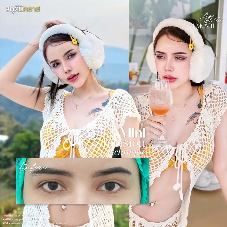 ผลลัพธ์การทำตาสองชั้นด้วยเทคนิคแผลเล็ก (Mini Incision)