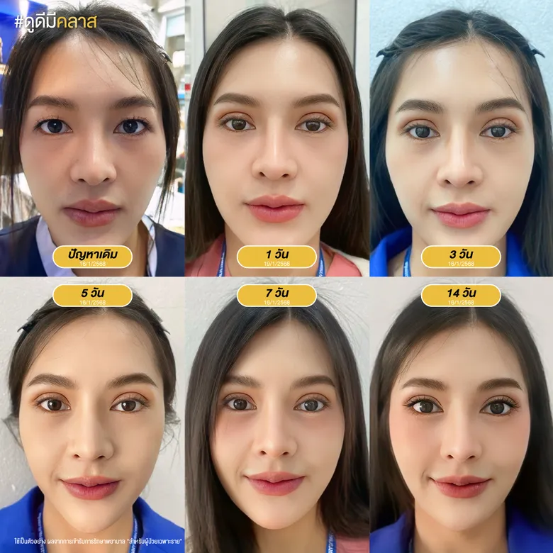 ระยะเวลาการฟื้นตัวหลังทำตาสองชั้น