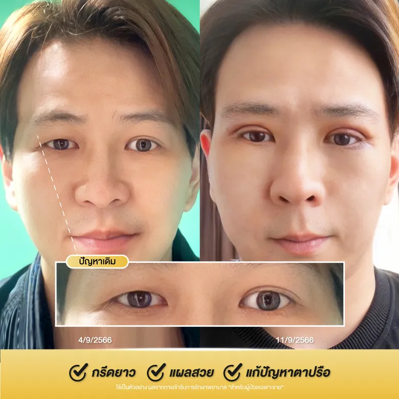 การแก้ไขปัญหากล้ามเนื้อตาอ่อนแรงและตาปรือ-01