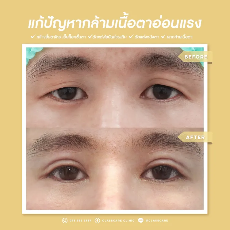 การแก้ไขปัญหากล้ามเนื้อตาอ่อนแรงและตาปรือ-02