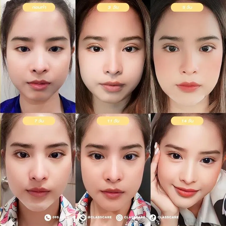 ลำดับเวลาการพักฟื้นและอัปเดตผลลัพธ์ในแต่ละช่วงวัน