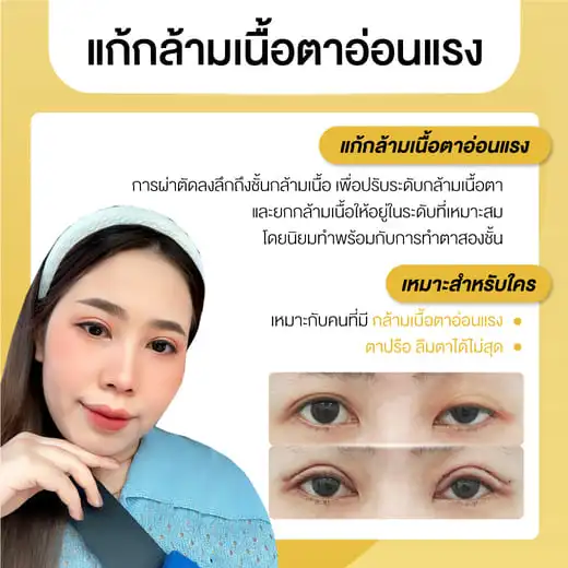 ข้อมูลการแก้กล้ามเนื้อตาอ่อนแรง