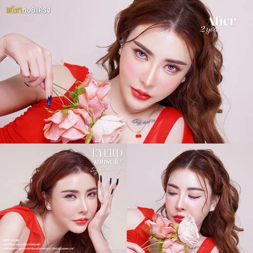 รีวิวเปรียบเทียบผลลัพธ์หลังทำตาสองชั้น