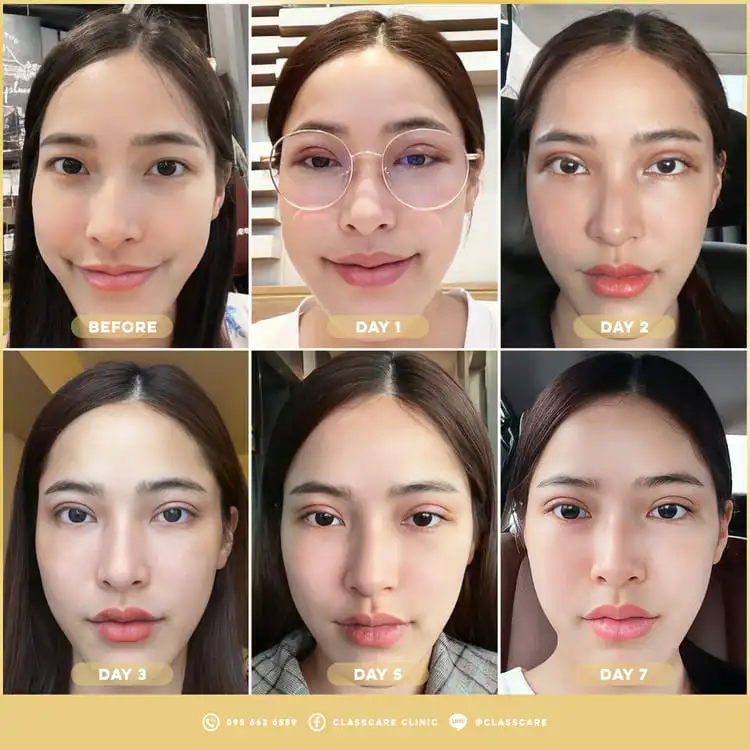 รีวิวทำตาสองชั้น