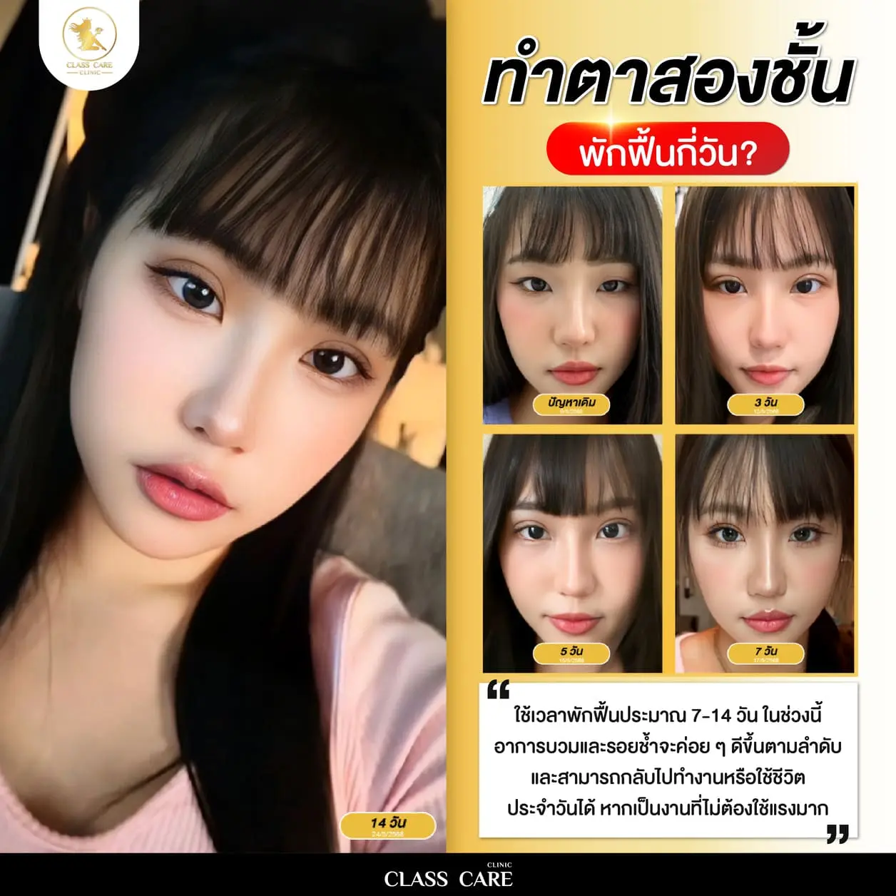 วิธีดูแลตัวเองและระยะเวลาพักฟื้นหลังทำตา