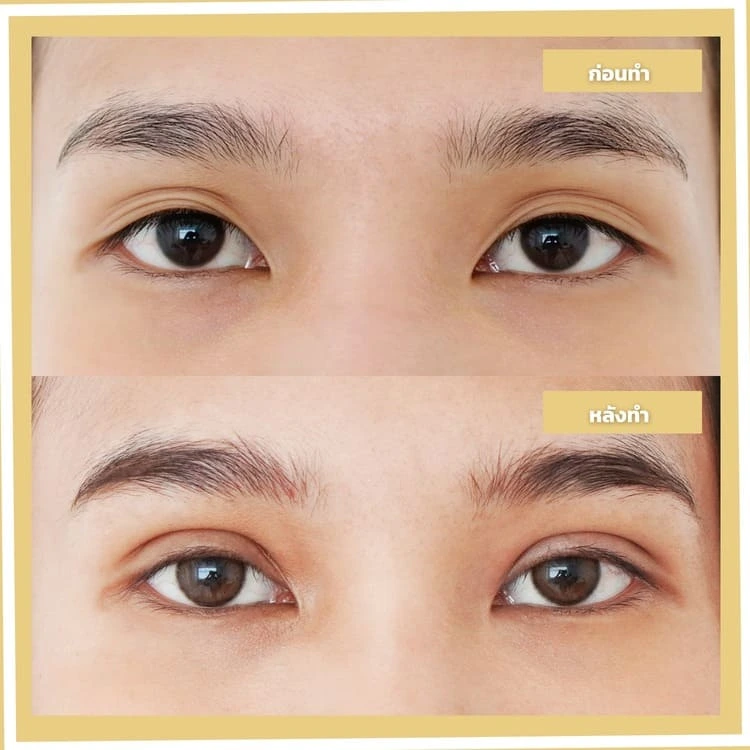 สาเหตุและวิธีแก้ปัญหาตาหลายชั้น