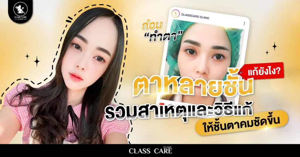 ตาหลายชั้น แก้ยังไง? รวมสาเหตุและวิธีแก้ให้ชั้นตาคมชัดขึ้น