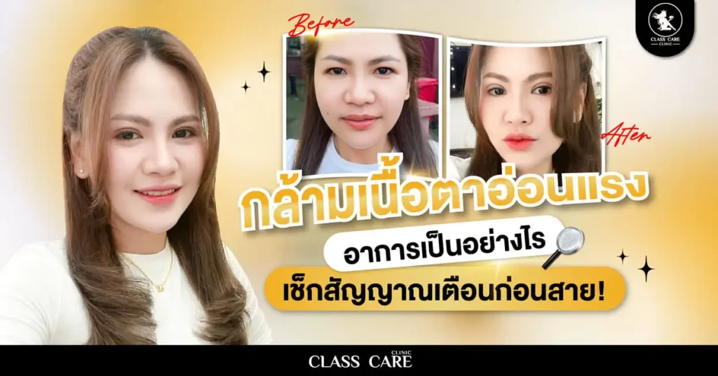 กล้ามเนื้อตาอ่อนแรง อาการเป็นอย่างไร? เช็กสัญญาณเตือนก่อนสาย