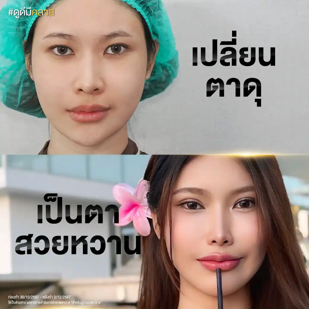 การทำตาสองชั้นด้วยวิธีฉีดยาชา เจ็บไหม?