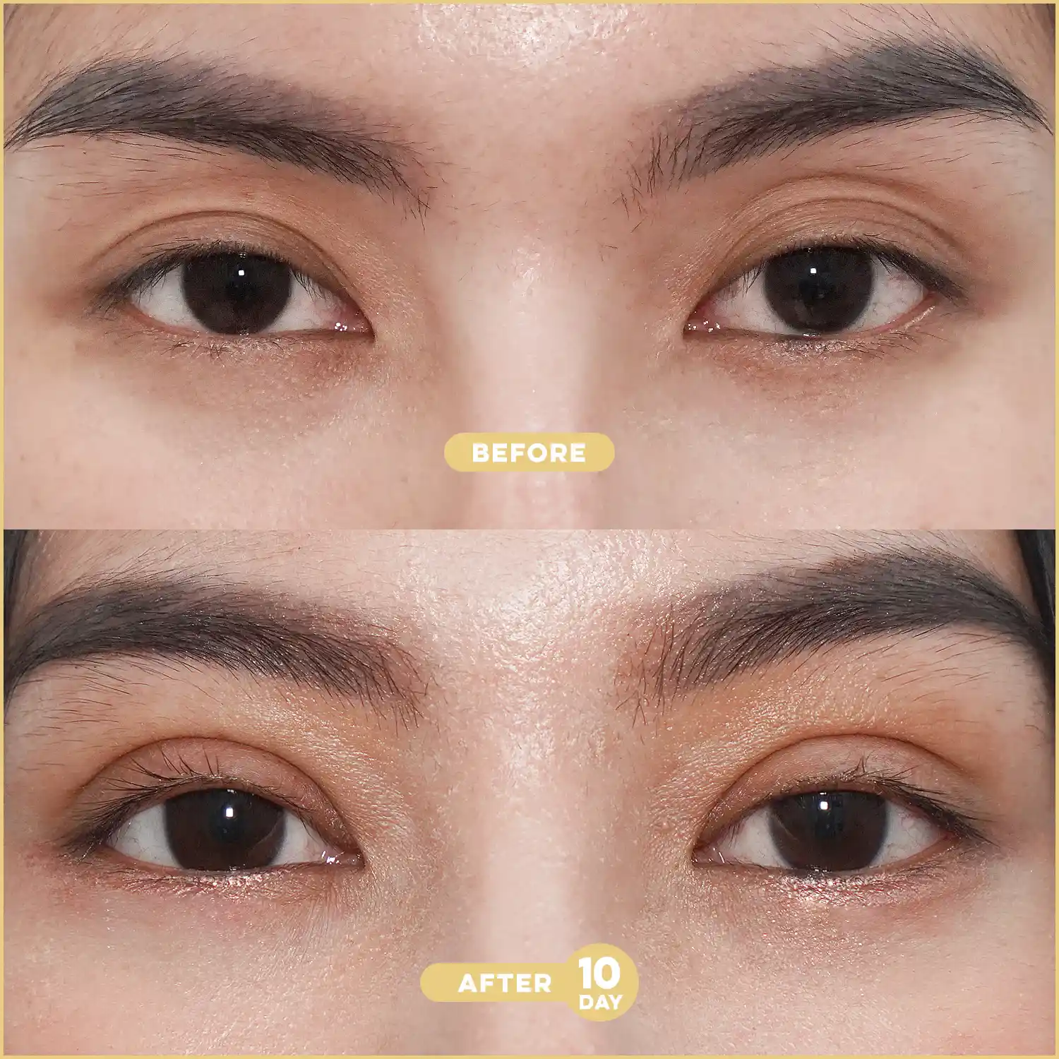 ตาปรือ ตาดูง่วงตลอดเวลา คืออะไร? มีลักษณะอย่างไร