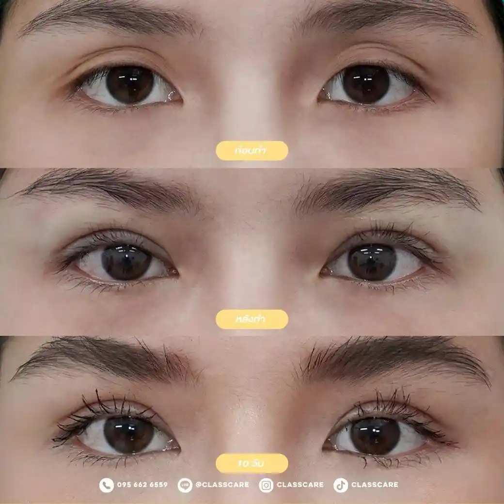 วิธีแก้ตาปรือ ตาดูง่วงตลอดเวลาด้วยการทำศัลยกรรมตาสองชั้น