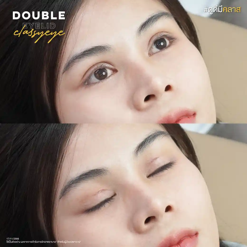 วิธีดูแลแผลหลังตัดไหมตาสองชั้น