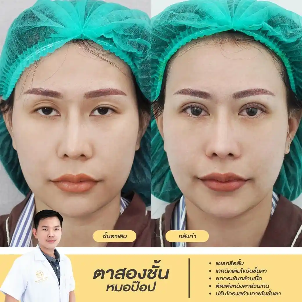 วิธีแก้ไขแววตาเศร้า ให้กลับมาดูสดใสด้วยวิธีทางการแพทย์