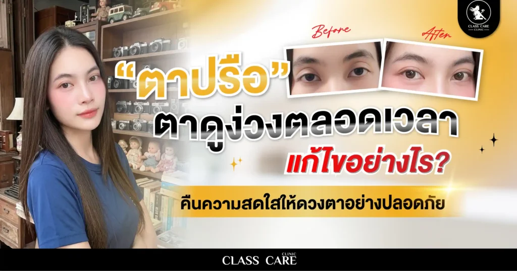 ตาปรือ ตาดูง่วงตลอดเวลาแก้ไขอย่างไร เติมเต็มความสดใสให้ดวงตา