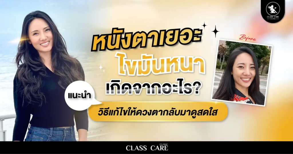 ปัญหาหนังตาเยอะ ไขมันหนาเกิดจากอะไร พร้อมวิธีแก้ไข
