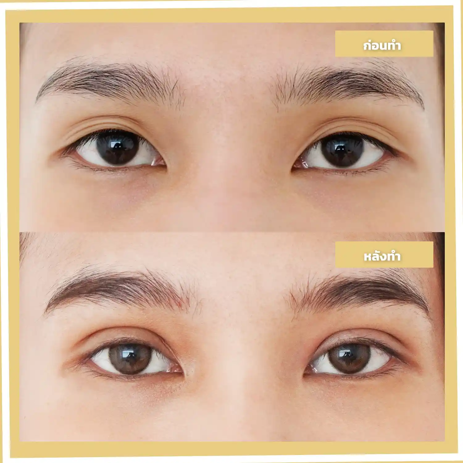 หนังตาเยอะ คืออะไร? มีลักษณะอย่างไร?