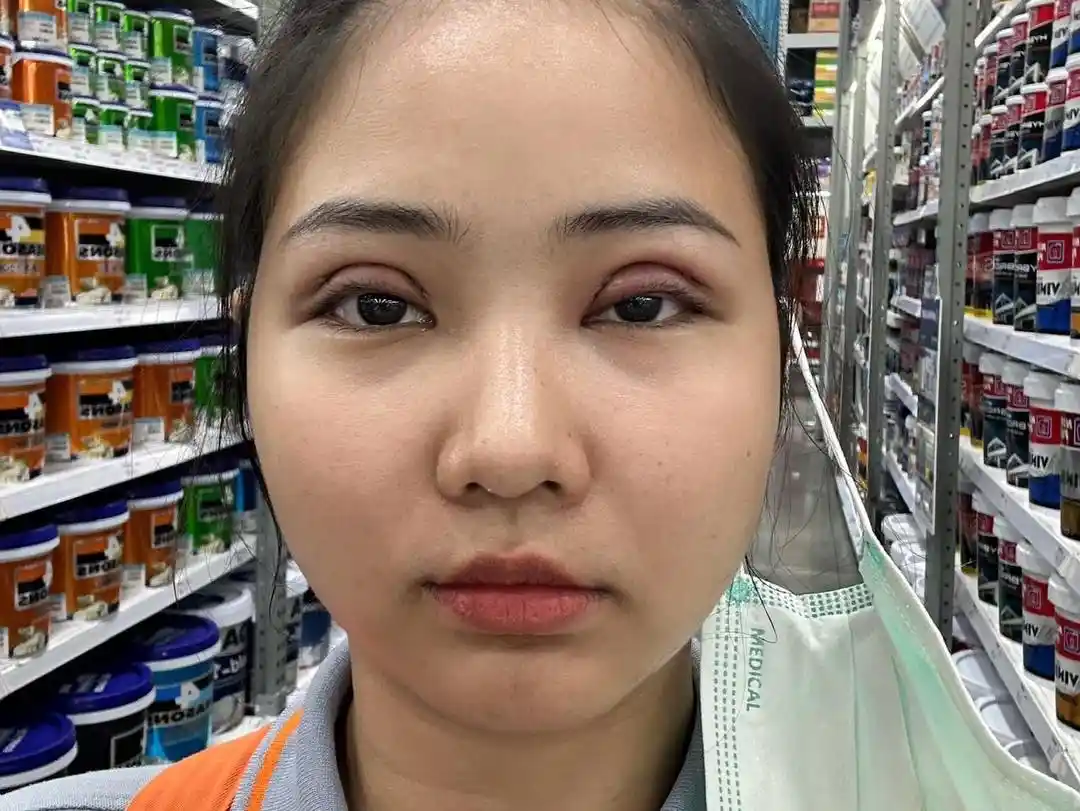 อาการบวมหลังทำตาสองชั้นเกิดจากอะไร?