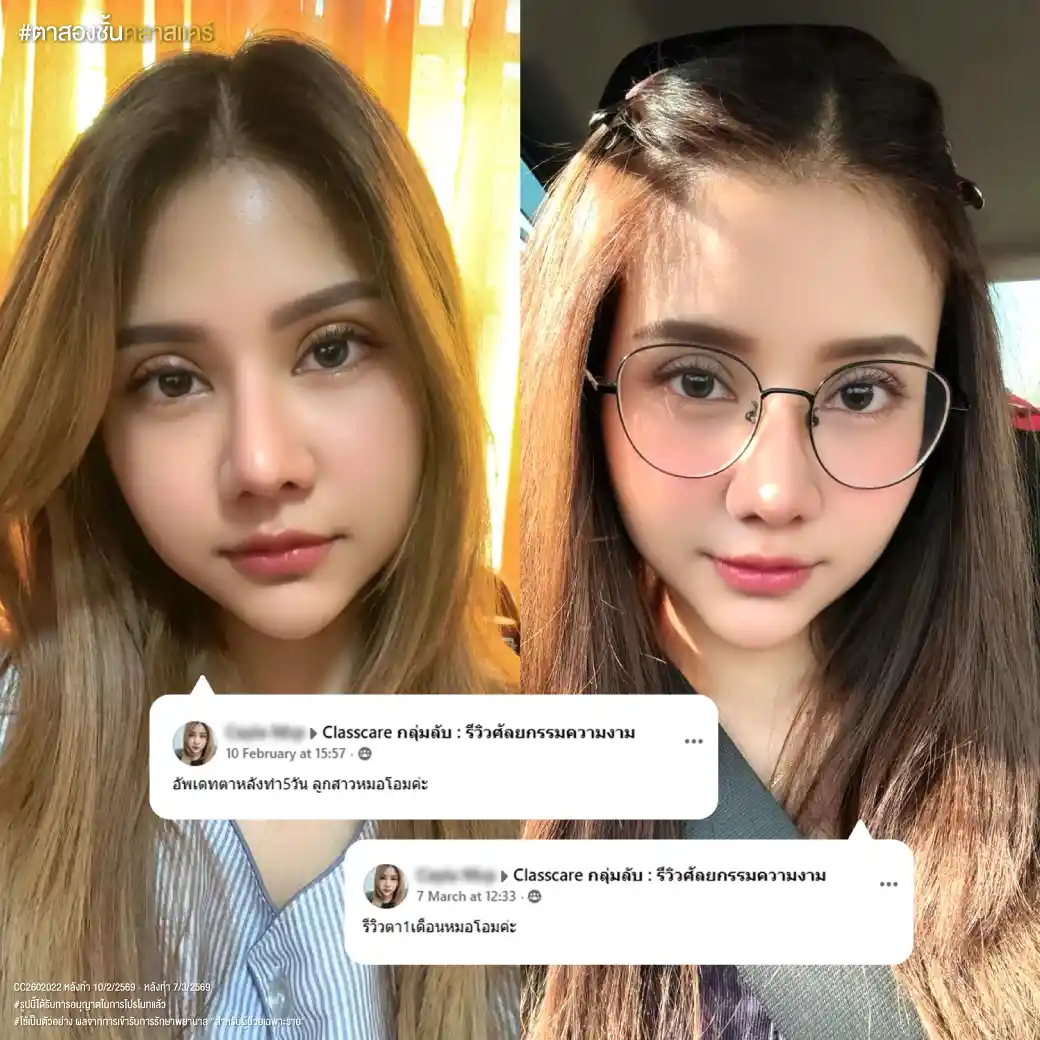 หลังทำตาแล้วใส่แว่นสายตาได้เลยไหม?