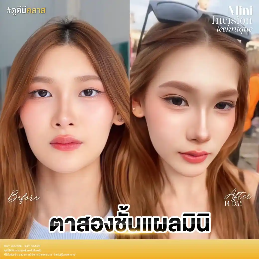 รีวิวตาสองชั้น Classcare Clinic-01