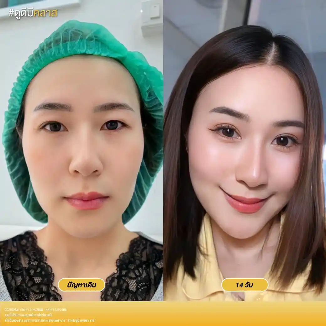 รีวิวตาสองชั้น Classcare Clinic-02