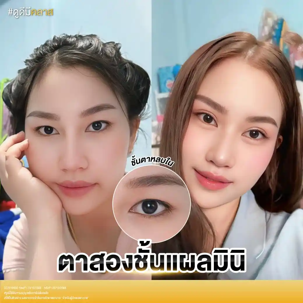รีวิวตาสองชั้น Classcare Clinic-03