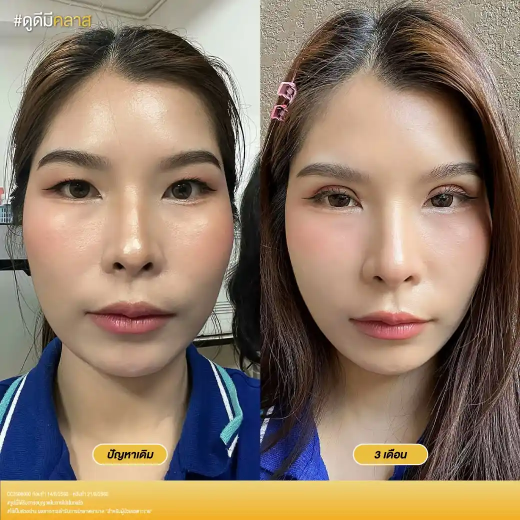 รีวิวตาสองชั้น Classcare Clinic-04
