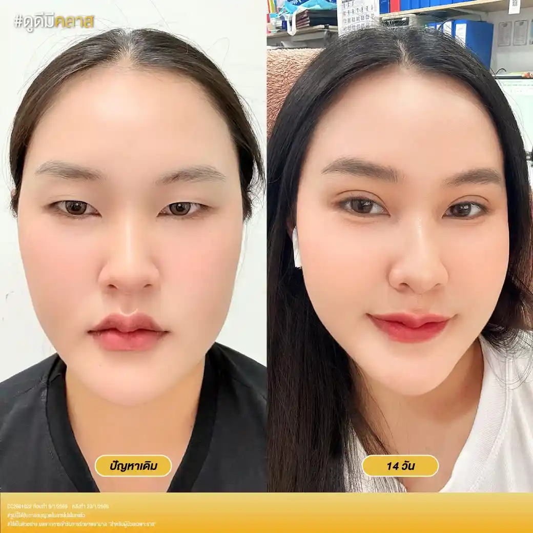 รีวิวตาสองชั้น Classcare Clinic-06