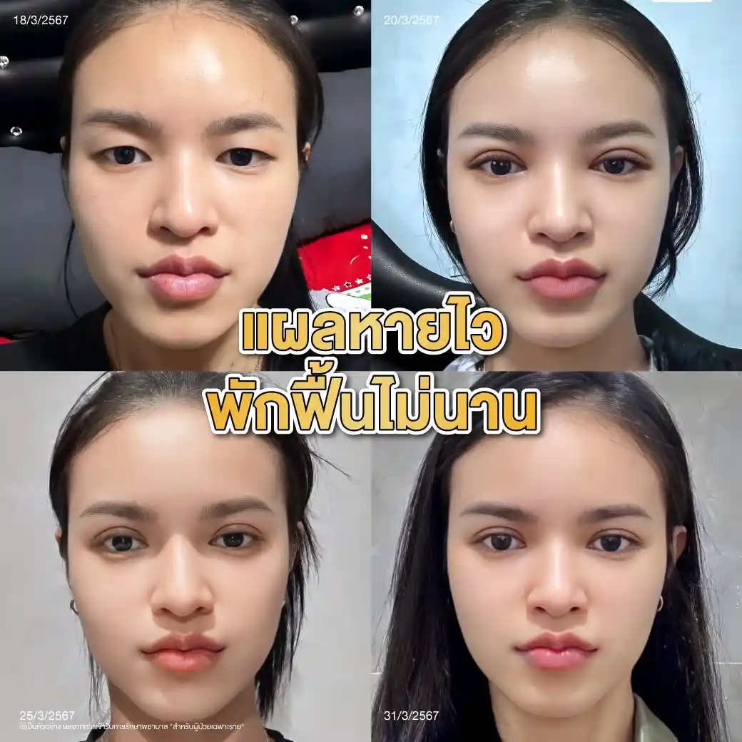 วิธีดูแลตัวเองหลังทำตาสองชั้นและฉีดโปรแกรมโบท็อกซ์