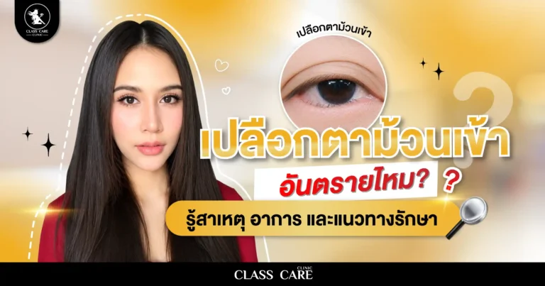 เปลือกตาม้วนเข้าอันตรายไหม? รู้สาเหตุ อาการ และแนวทางรักษา
